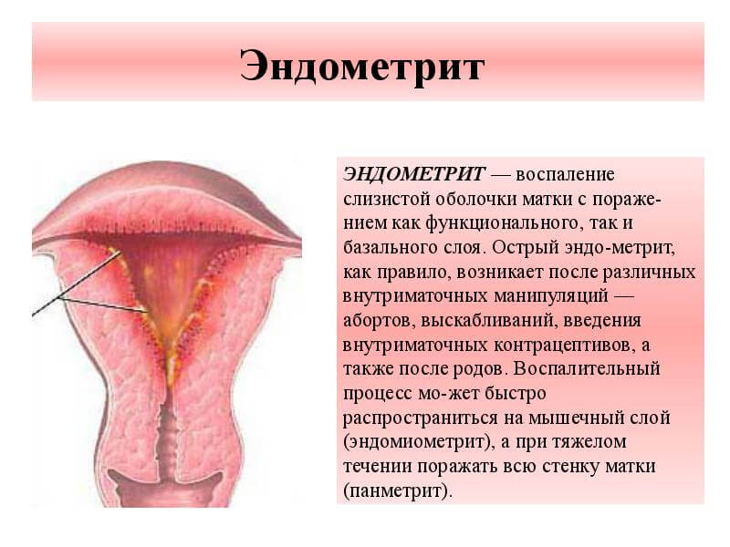 Как лечить воспаление слизистой оболочки матки Как лечить воспаление слизистой оболочки матки