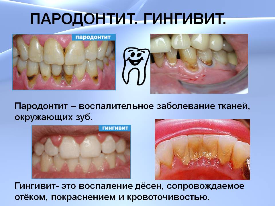 Лечение язв на деснах в домашних условиях Лечение язв на деснах в домашних условиях