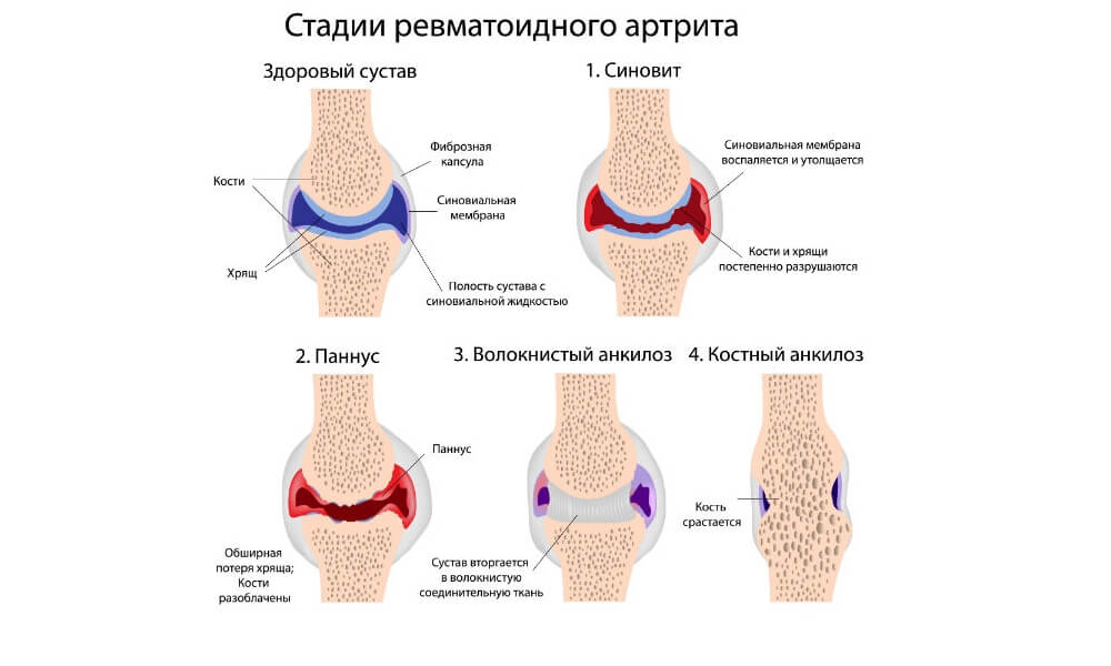 Сколько стадий у артрита Сколько стадий у артрита
