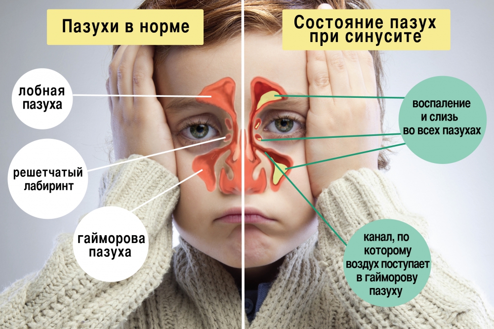Как лечат синусит у взрослых в домашних условиях Как лечат синусит у взрослых в домашних