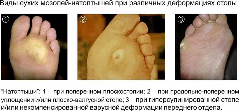 Чем вывести сухой мозоль на пальце ноги в домашних условиях Чем вывести сухой мозоль на пальце ноги