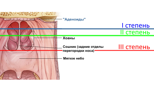 Stepeni-adenoidnogo-vospalenija